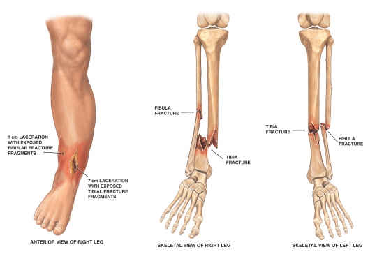 FibulaFracture